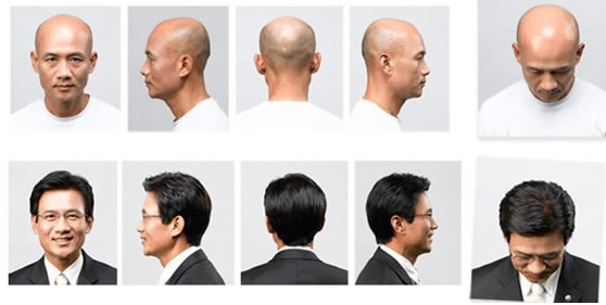 廣州這邊禿頂怎么辦？可以修復(fù)么？