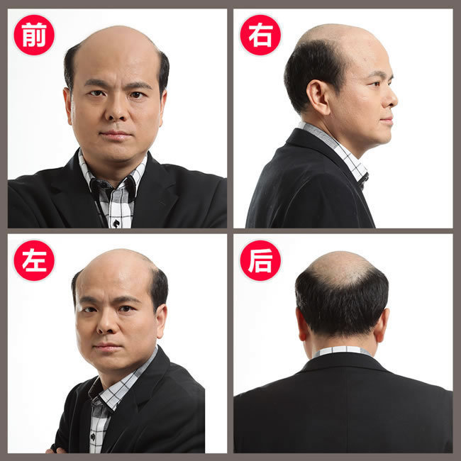 前額兩邊頭發(fā)稀疏怎么辦？看了你就知道怎么解決！