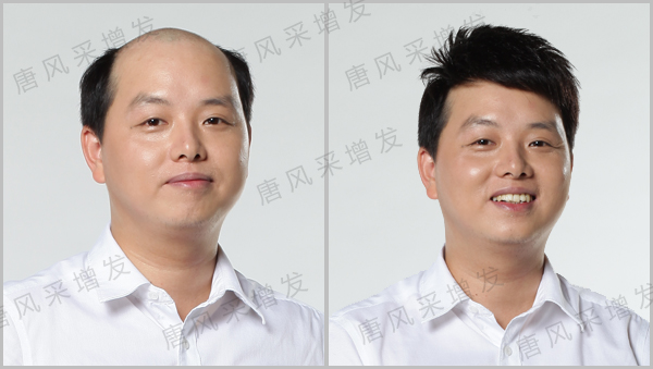 白發(fā)脫發(fā)可不可以進(jìn)行織發(fā)？