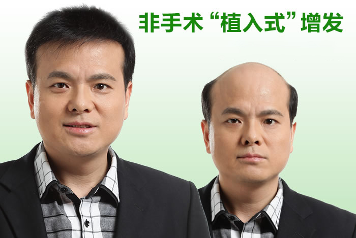 真人假發(fā)織發(fā)補(bǔ)發(fā)有什么優(yōu)勢(shì)？