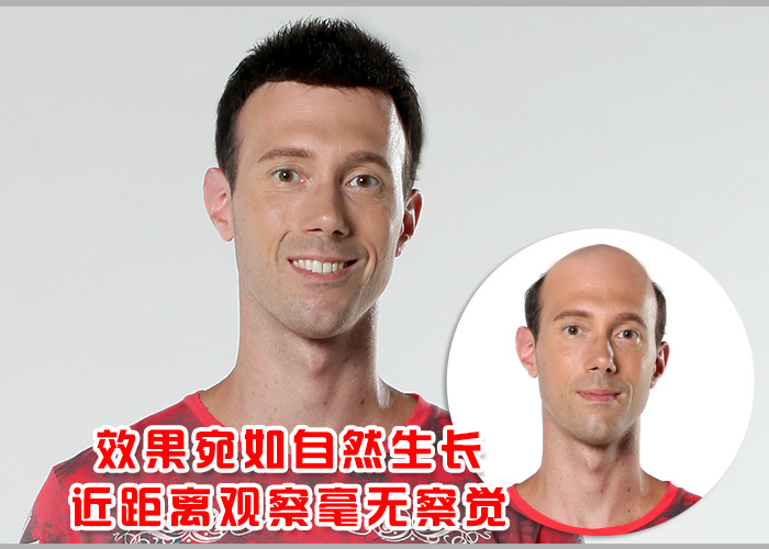 禿發(fā)可以補發(fā)嗎？補發(fā)會掉嗎？