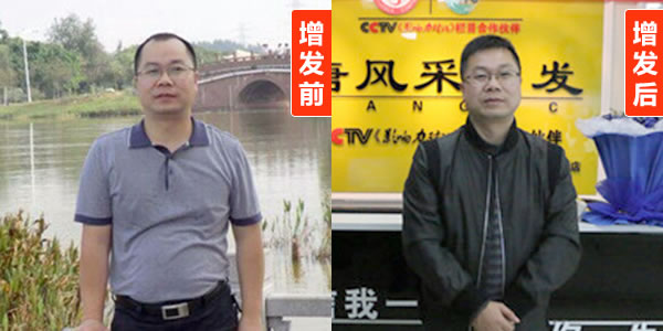 頭發(fā)再生的方法有哪些？看了你就知道了！