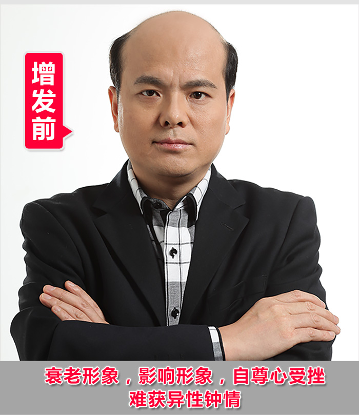 脫發(fā)禿頂?shù)目诵恰鹕剿饺硕ㄖ聘叨思侔l(fā)！