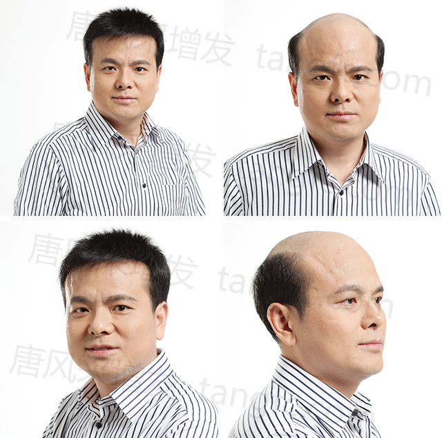 柳州有哪些織發(fā)補發(fā)店？店多，但織發(fā)技術(shù)好的店卻不多