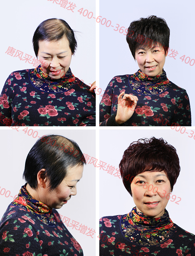 合肥織發(fā)定制解決脫發(fā)，什么品牌值得信賴？