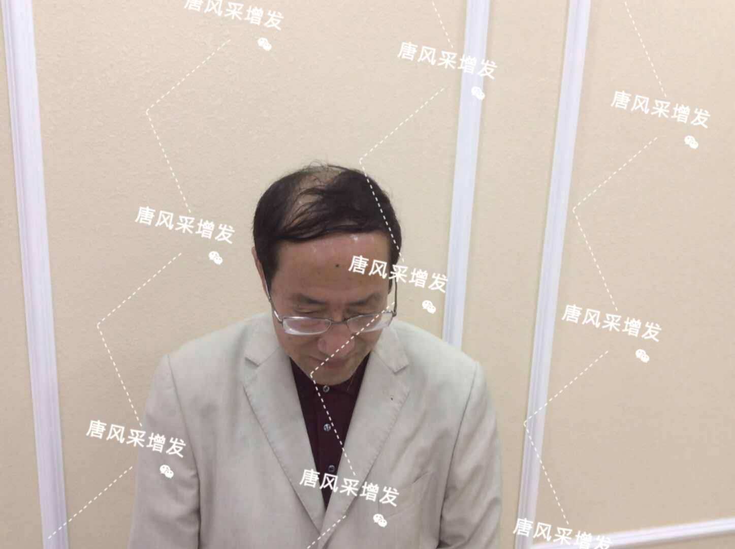 脫發(fā)禿頂成中年男人標(biāo)配？唐風(fēng)采增發(fā)讓您風(fēng)采始終如一