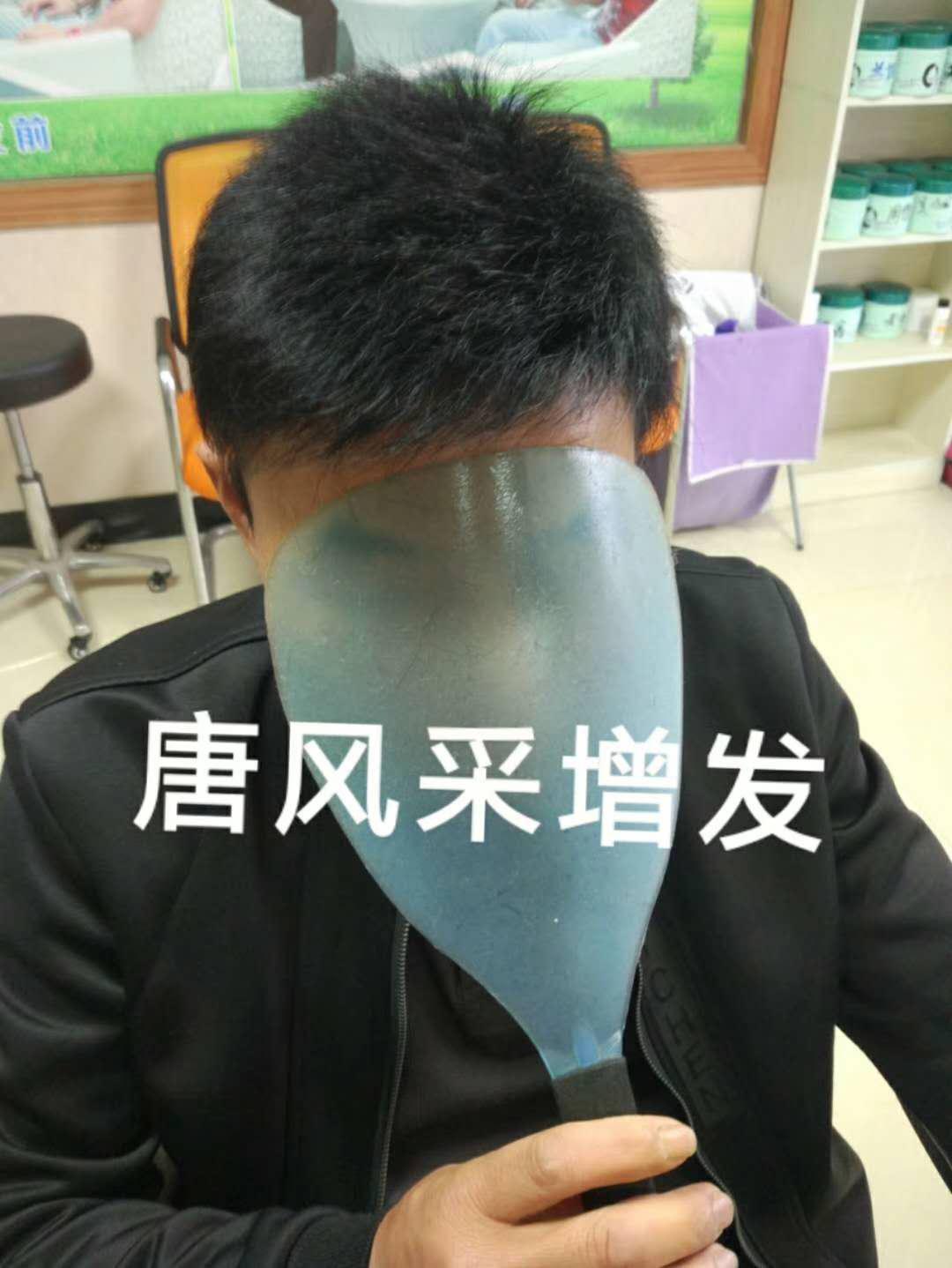 脫發(fā)謝頂壓力大，增發(fā)補(bǔ)發(fā)一身輕！
