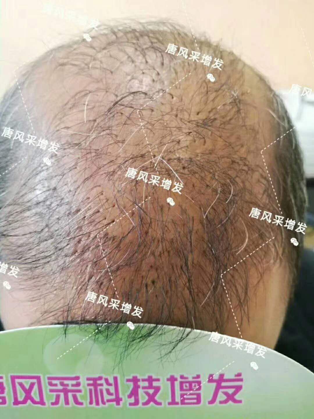 頭發(fā)稀少怎么變密？