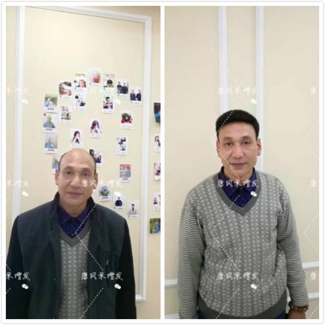頭發(fā)少怎么辦？