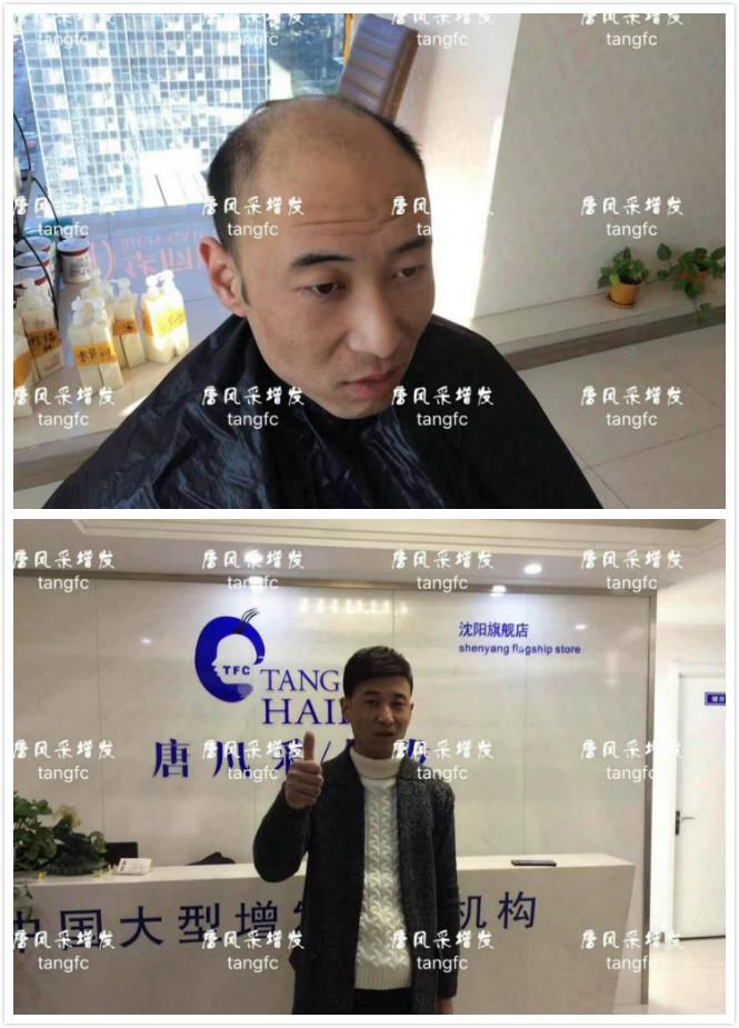為脫發(fā)者解千愁，增發(fā)前后的驚人對(duì)比！