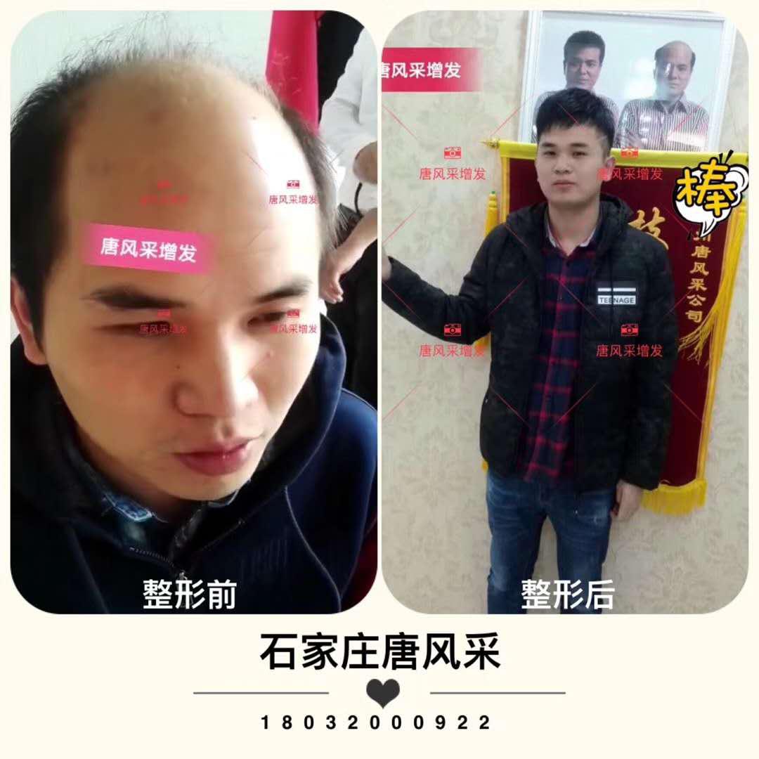 頭發(fā)少怎么辦？