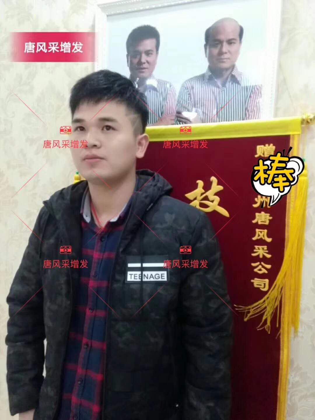 為脫發(fā)者解千愁，增發(fā)前后的驚人對(duì)比！