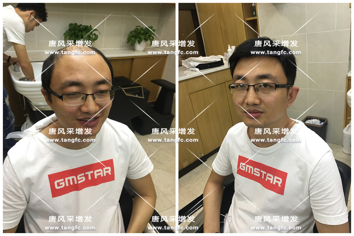 謝頂會(huì)坑一輩子？ 我不禁摸了摸自己頭發(fā)