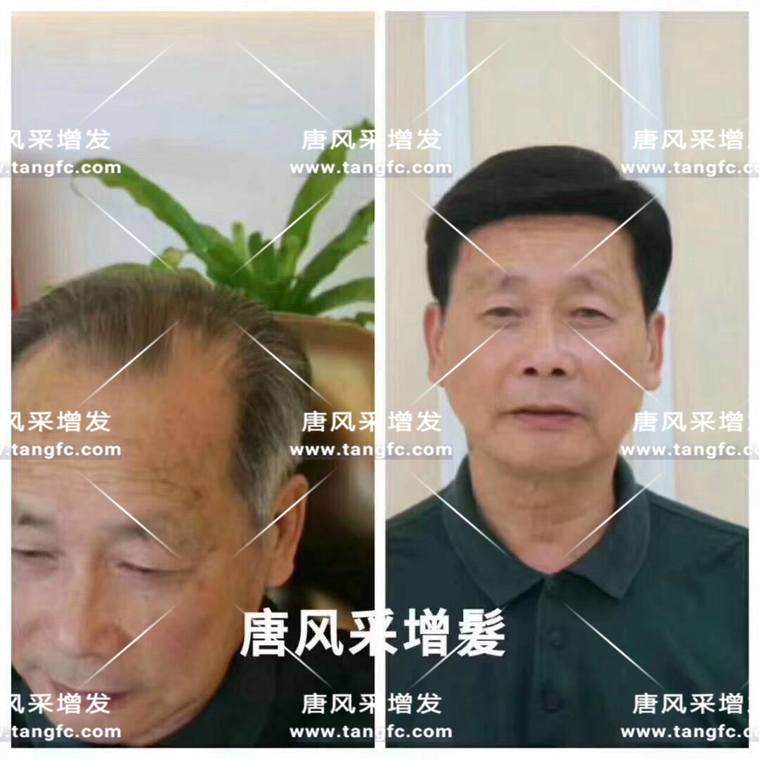 謝頂會(huì)坑一輩子？ 我不禁摸了摸自己頭發(fā)