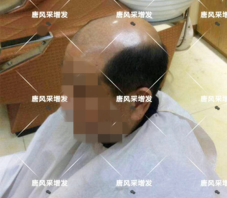 男人脫發(fā)原因多，不能一味怨腎虧！