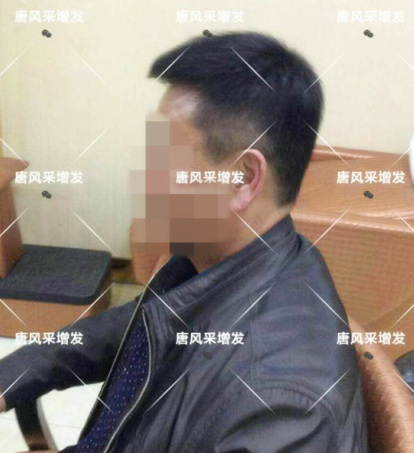 男人脫發(fā)原因多，不能一味怨腎虧！