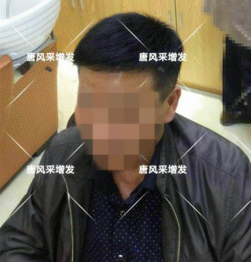 男人脫發(fā)原因多，不能一味怨腎虧！