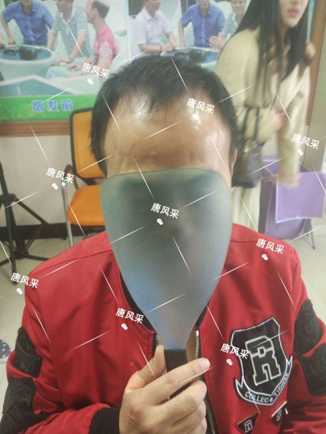 男人脫發(fā)原因多，不能一味怨腎虧！