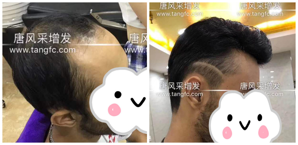 男士假發(fā)容易看出來嗎？看看做過頭發(fā)的發(fā)友怎么說！