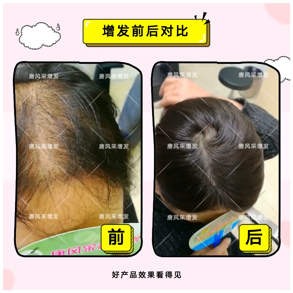 烏魯木齊買隱形假發(fā)哪家好？鳳凰涅槃造就美麗傳說！