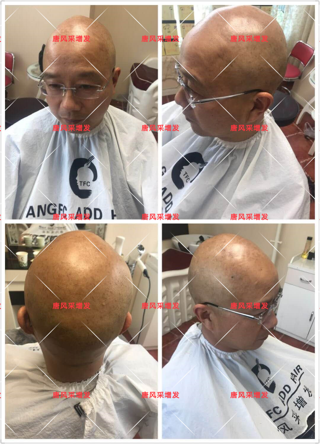 10年脫發(fā)困擾，一次性解決，唐風采助力查先生“夢想成真”