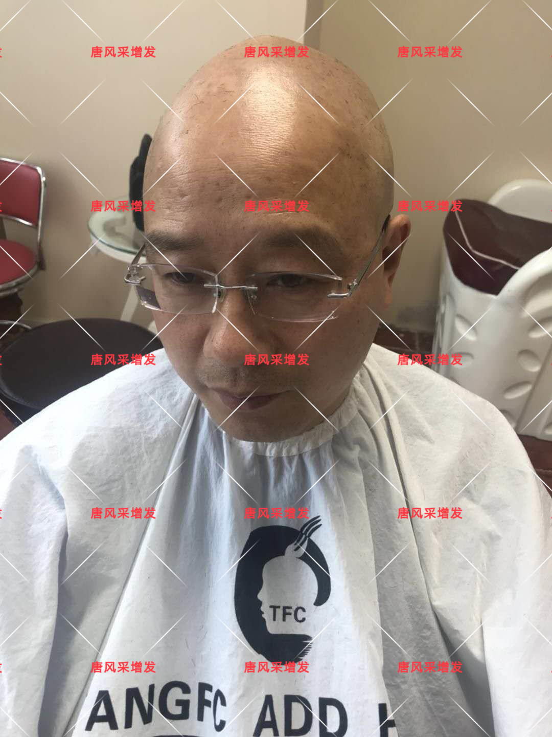 10年脫發(fā)困擾，一次性解決，唐風采助力查先生“夢想成真”