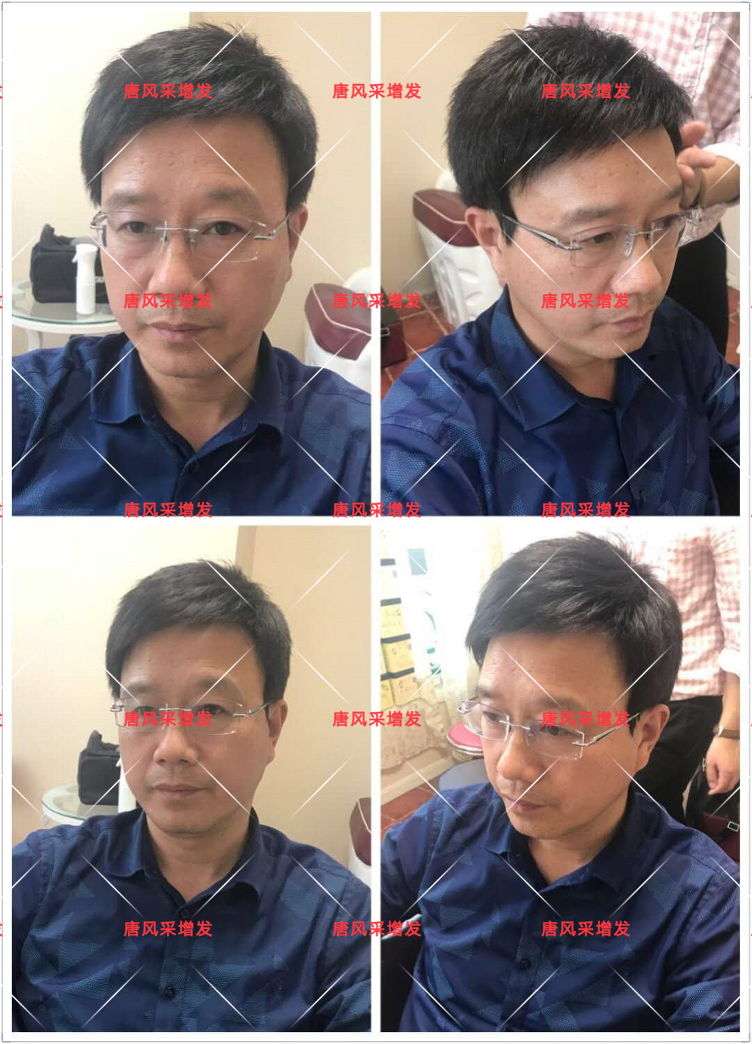 10年脫發(fā)困擾，一次性解決，唐風采助力查先生“夢想成真”