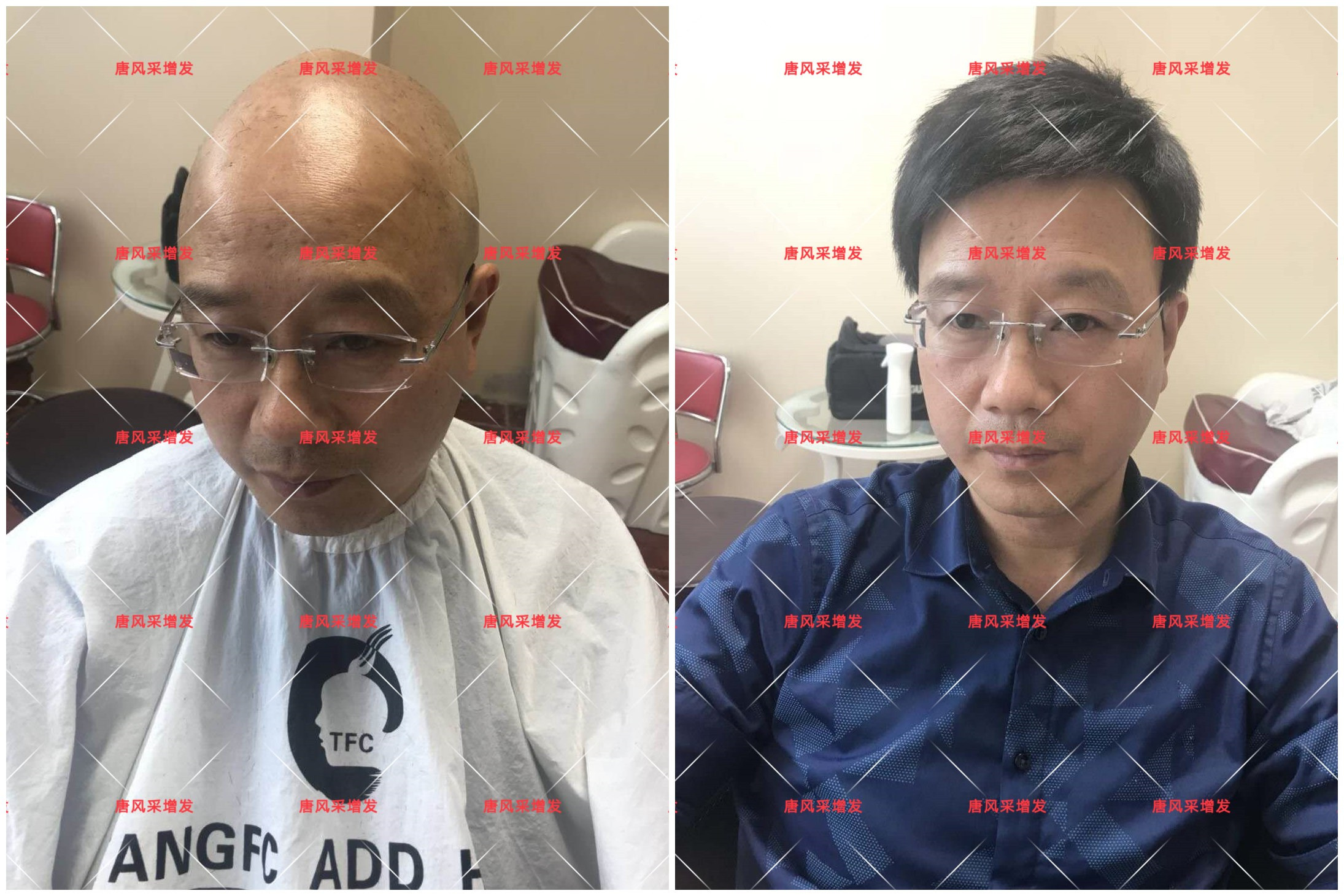 10年脫發(fā)困擾，一次性解決，唐風采助力查先生“夢想成真”