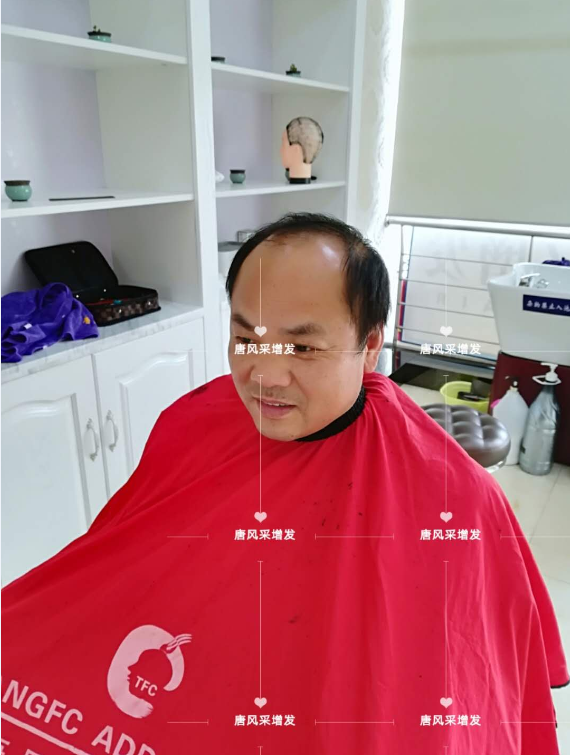 脫發(fā)不分地域，唐風(fēng)采增發(fā)助力北京爺們