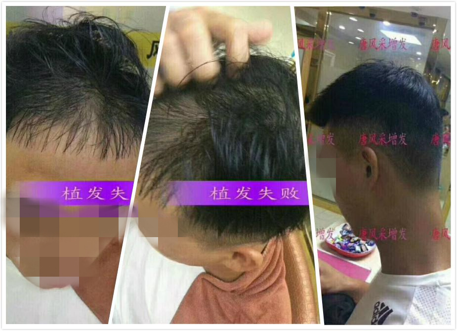 開始脫發(fā)的朋友上醫(yī)院，見到專家后他徹底絕望了！