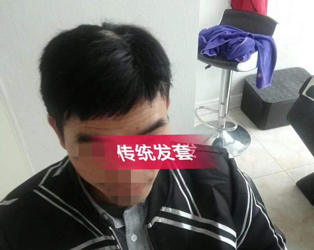 開始脫發(fā)的朋友上醫(yī)院，見到專家后他徹底絕望了！