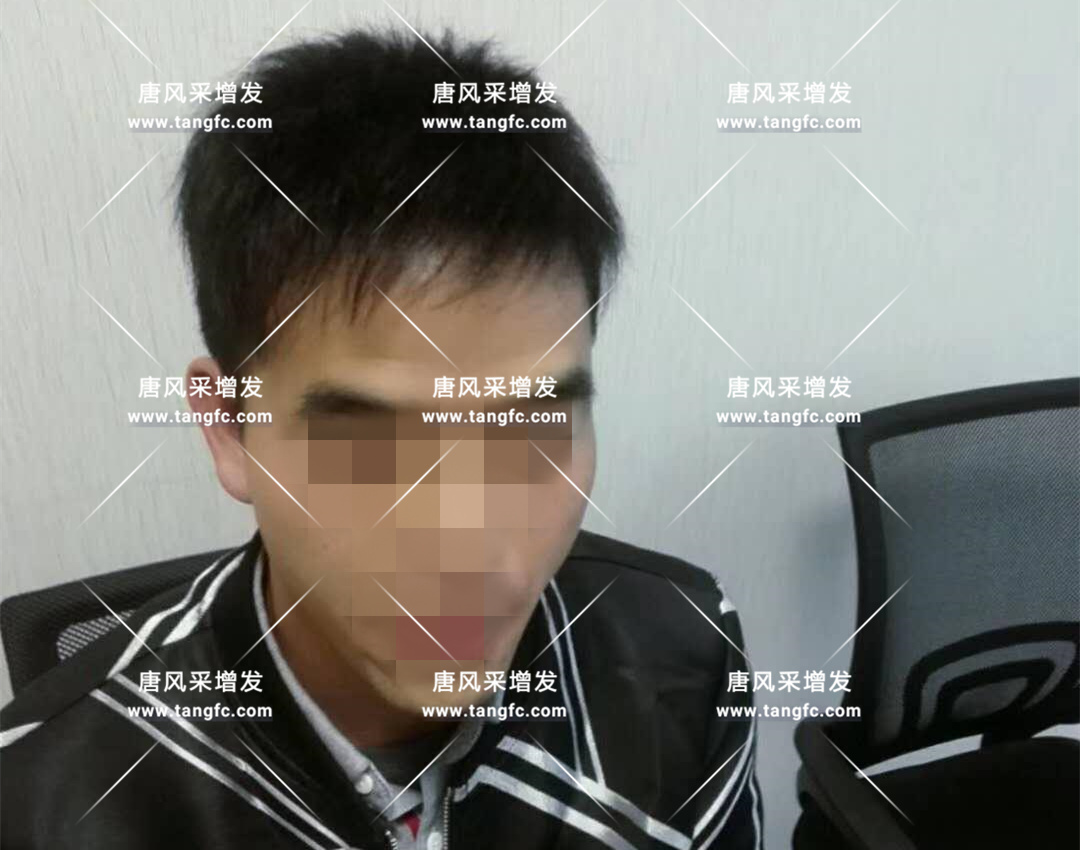 開始脫發(fā)的朋友上醫(yī)院，見到專家后他徹底絕望了！