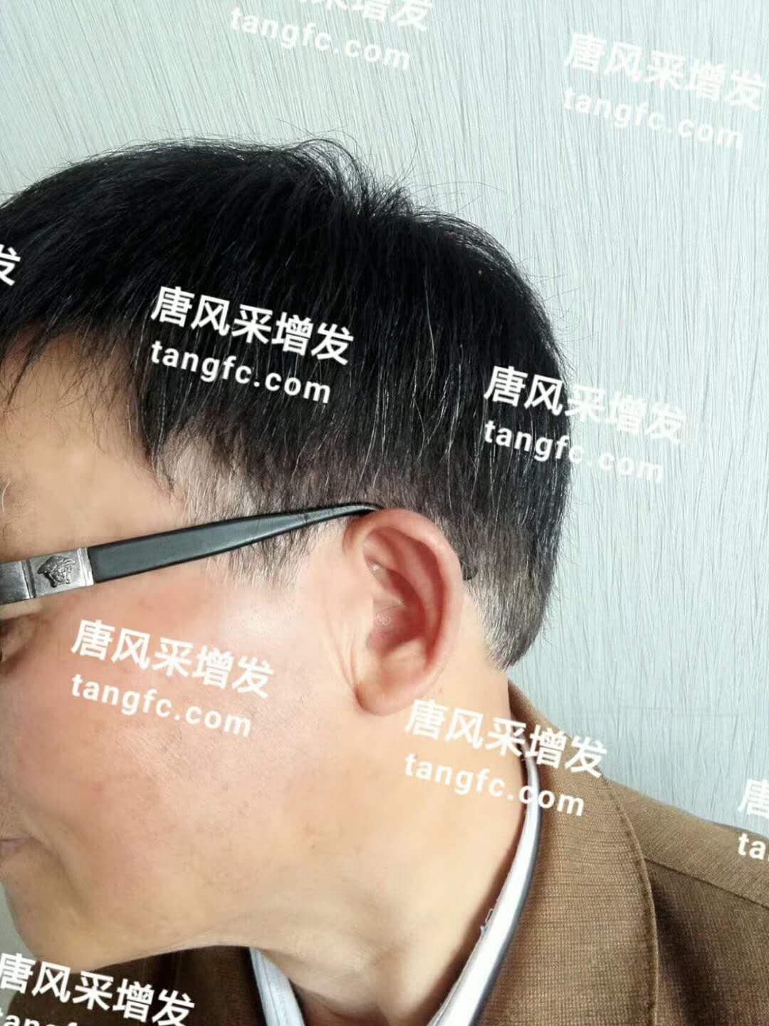 開始脫發(fā)的朋友上醫(yī)院，見到專家后他徹底絕望了！