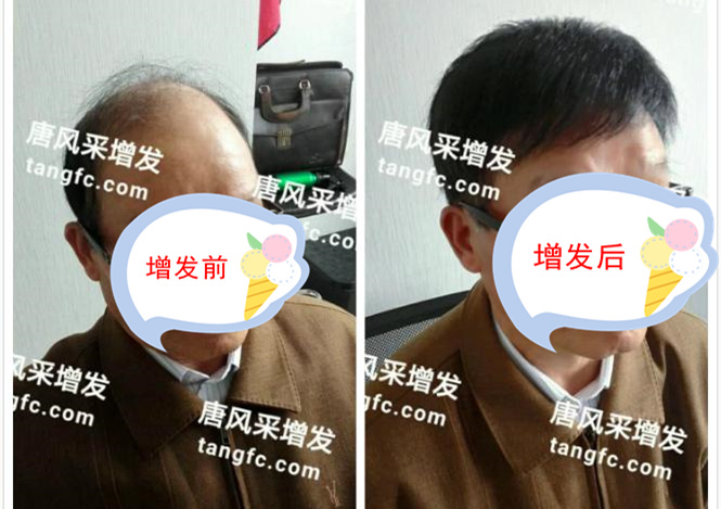 開始脫發(fā)的朋友上醫(yī)院，見到專家后他徹底絕望了！