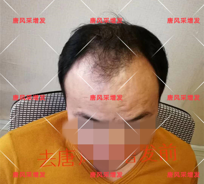 謝頂是顏值也拯救不了的尷尬！