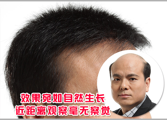 別再嘲笑我，我的禿頂已經(jīng)解決了！