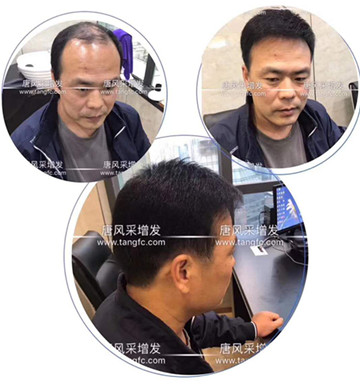 如何避免成為一個(gè)脫發(fā)的中年猥瑣男人？