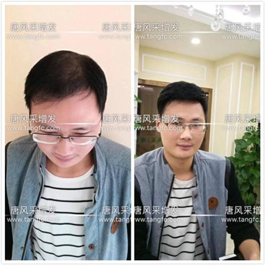 如何避免成為一個(gè)脫發(fā)的中年猥瑣男人？