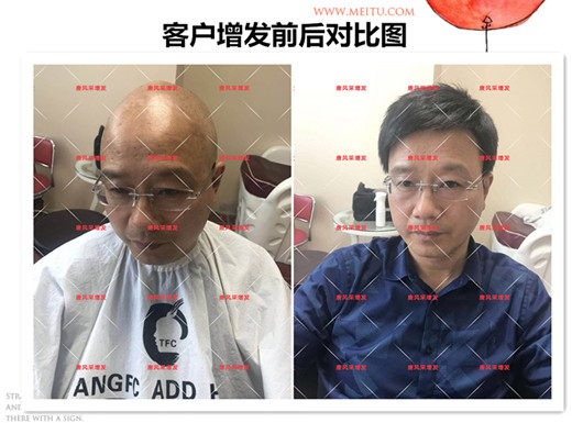 雙節(jié)同慶，給脫發(fā)的父親什么禮物，讓父親“年輕10歲”的神