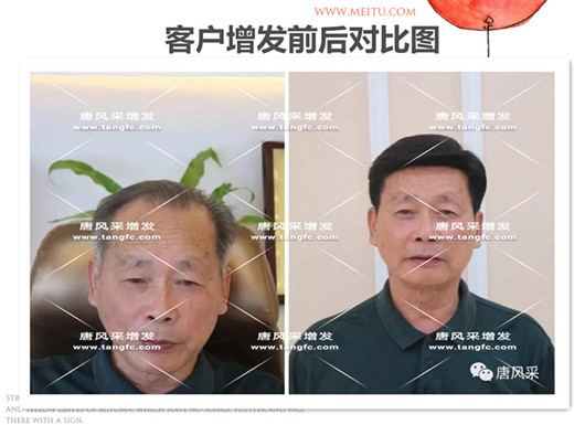 雙節(jié)同慶，給脫發(fā)的父親什么禮物，讓父親“年輕10歲”的神
