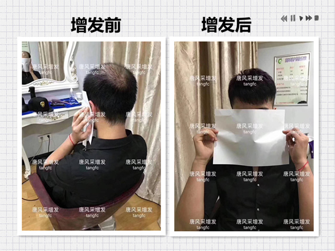 西寧補(bǔ)發(fā)哪里好誰(shuí)知道？ 90后脫發(fā)了想做補(bǔ)發(fā)！