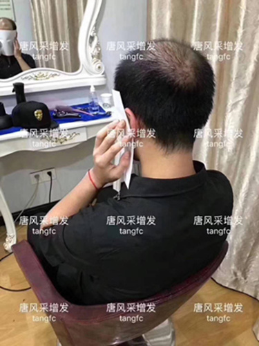 西寧補(bǔ)發(fā)哪里好誰(shuí)知道？ 90后脫發(fā)了想做補(bǔ)發(fā)！