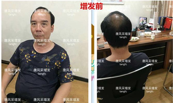 如何生發(fā)密發(fā)?到底有沒(méi)有生發(fā)奇效的藥物呢？