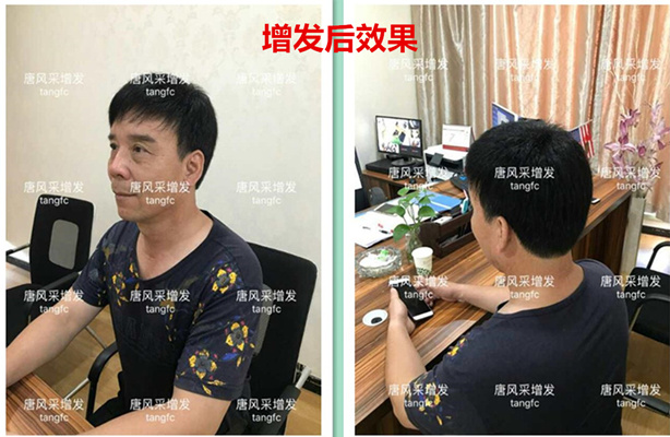 如何生發(fā)密發(fā)?到底有沒(méi)有生發(fā)奇效的藥物呢？