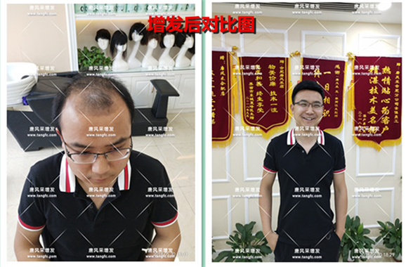他被脫發(fā)“啃老”是與遺傳有關(guān)啊！