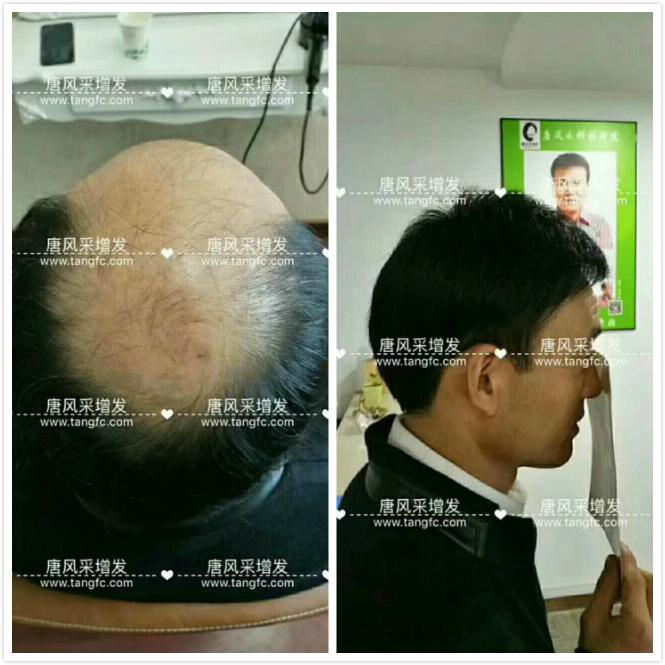 臺州哪里買假發(fā)好，頭發(fā)稀疏適合什么樣的假發(fā)？