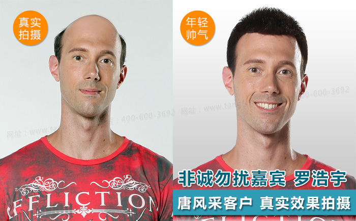 臺州哪里買假發(fā)好，頭發(fā)稀疏適合什么樣的假發(fā)？