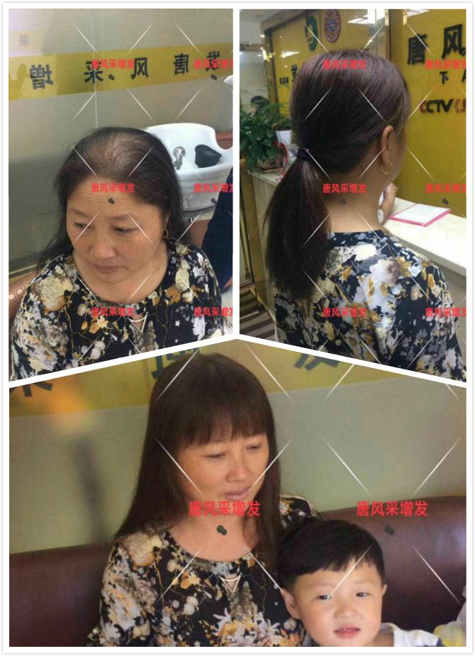 西寧織發(fā)補(bǔ)發(fā)哪家好，真的能改變我的脫發(fā)形象嗎？ 