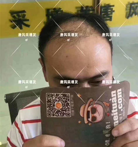 西寧織發(fā)補(bǔ)發(fā)哪家好，真的能改變我的脫發(fā)形象嗎？ 
