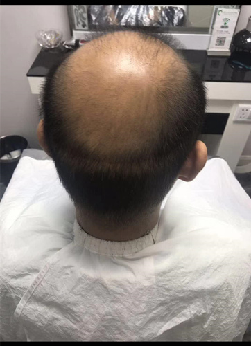 西寧織發(fā)補(bǔ)發(fā)哪家好，真的能改變我的脫發(fā)形象嗎？ 
